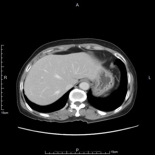 胃癌晚期化疗一次多少钱,胃癌晚期不化疗用靶向药