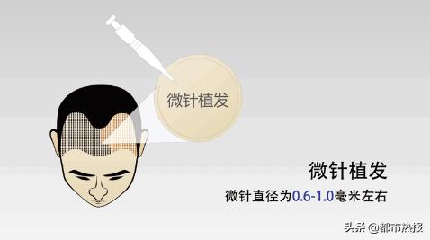 大麦植发跟大麦微针是一样的吗,大麦微针植发和新生3d植发哪家好