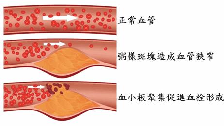 早期冠心病吃复方丹参滴丸可以吗,复方丹参滴丸治疗冠心病