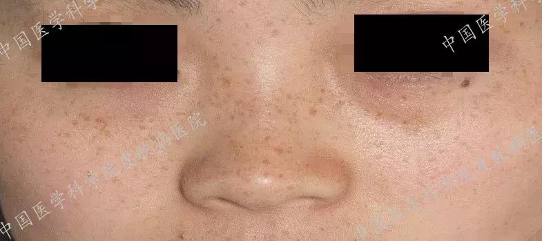 什么护肤品对晒斑有效,角质层薄有晒斑用什么护肤品