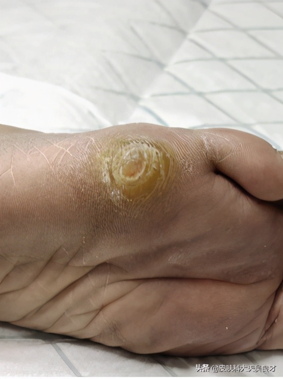 看完这篇文章后学到了什么,鸡眼和跖疣最简单的区别