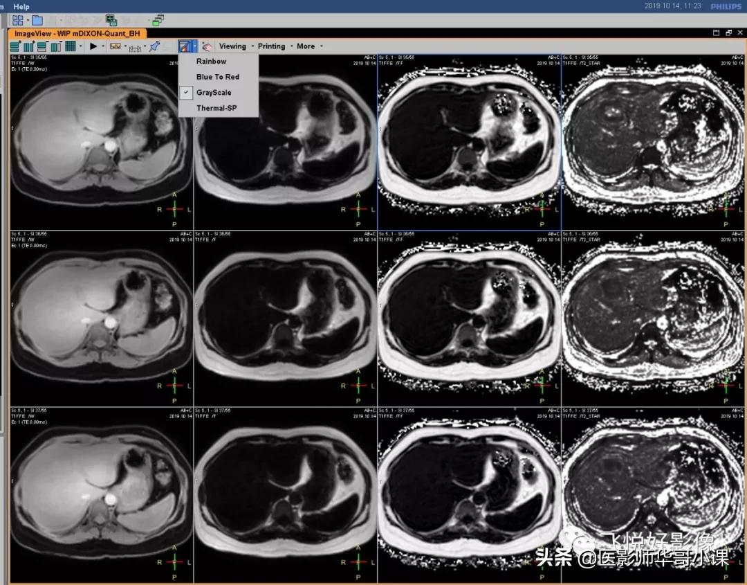 飞利浦磁共振快速扫描方案指南,飞利浦1.5t磁共振各部位扫描技术