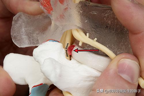 髓核游离型椎间盘突出,腰椎间盘突出髓核脱出症状