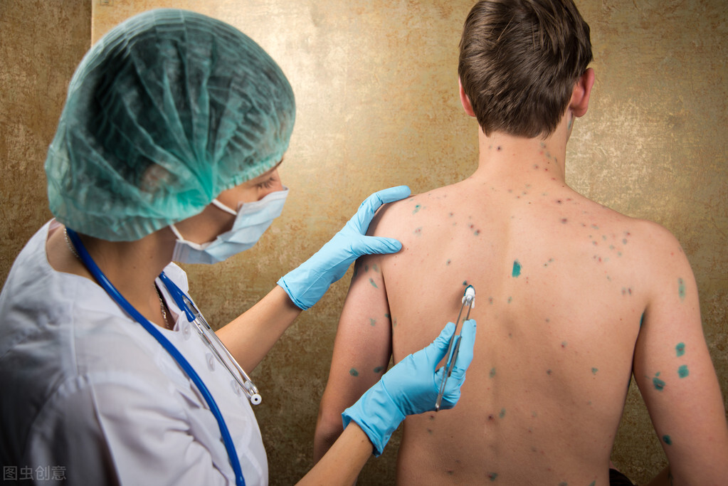 单纯疱疹最好的治疗方法,嘴上疱疹最好的治疗方法