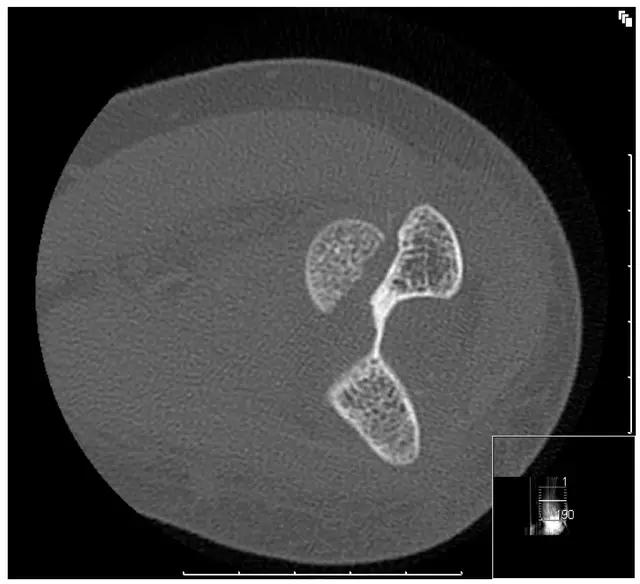 几种严重骨折医学名称,常见的骨折有哪些名称