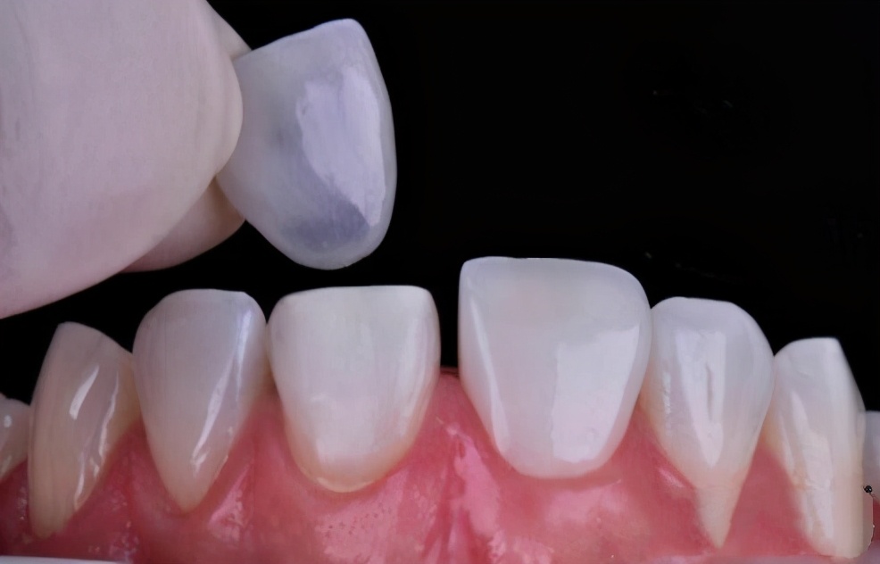 教你一个小妙招牙齿黄不用担心,教你治牙黄