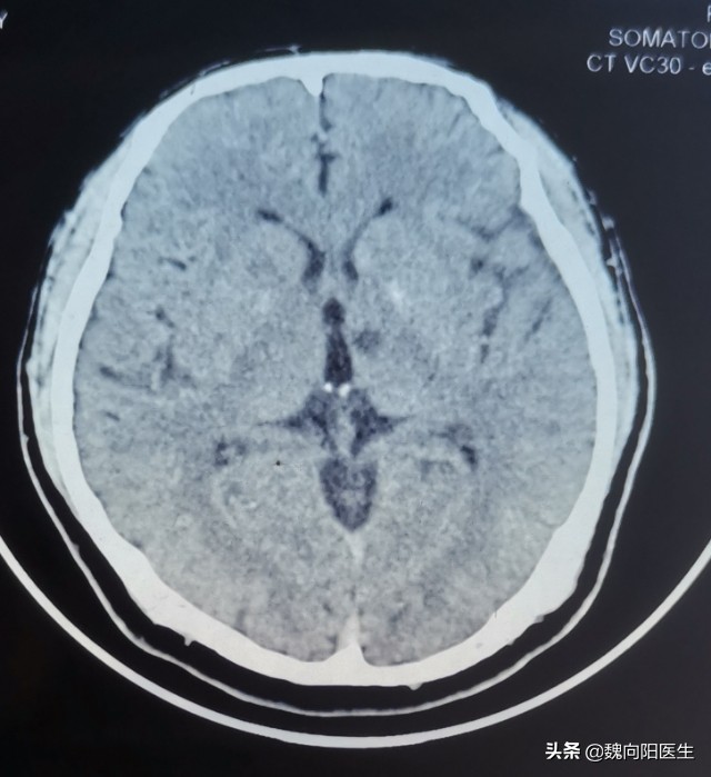缺血性卒中腔隙性脑梗死,检查结果是腔隙性脑梗死严重吗