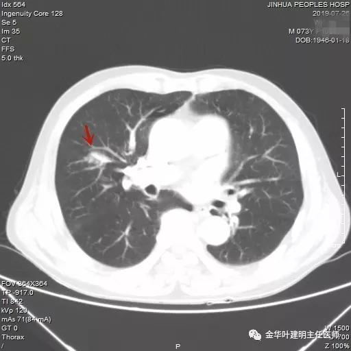 能不能手术,极重度混合性通气功能障碍能治吗
