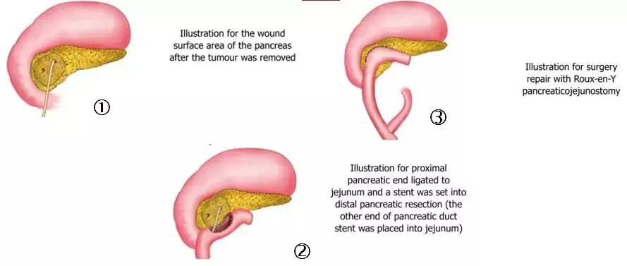 三院外科手术,胰管空肠桥式吻合术世界首创者