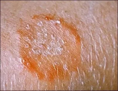 流浪猫猫癣是什么样的,金渐层猫得猫癣什么样