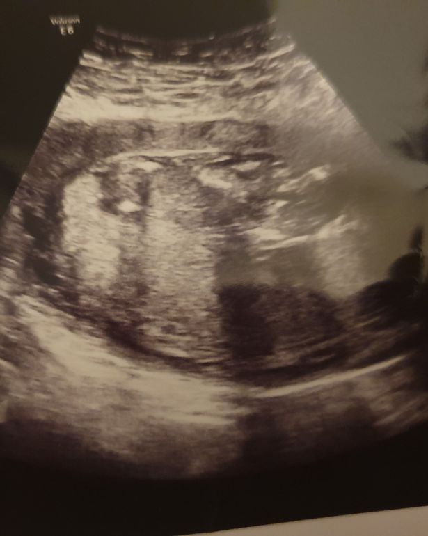 怀孕的孕妇羊水破了要生了,英国孕妇羊水破了