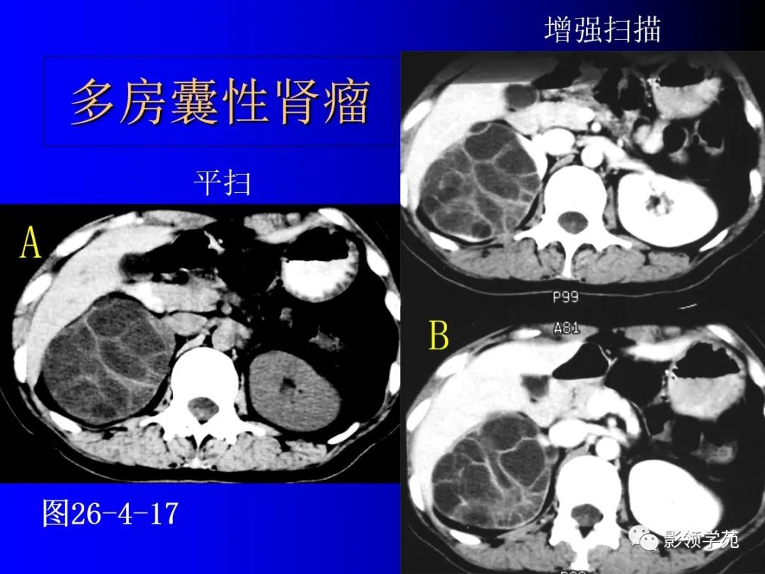 肾脏囊性肿块的影像学特点,肾脏典型病理图片及解析