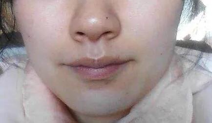 超皮秒激光褐青斑要注意什么,皮秒去除太田痣和激光去除的区别