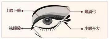 双眼皮、眼整形的误区，眼睛手术的坑，不要往里面跳了