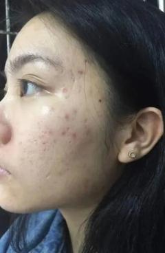 片仔癀淡化痘印凝胶,片仔癀祛痘痘贴有用吗