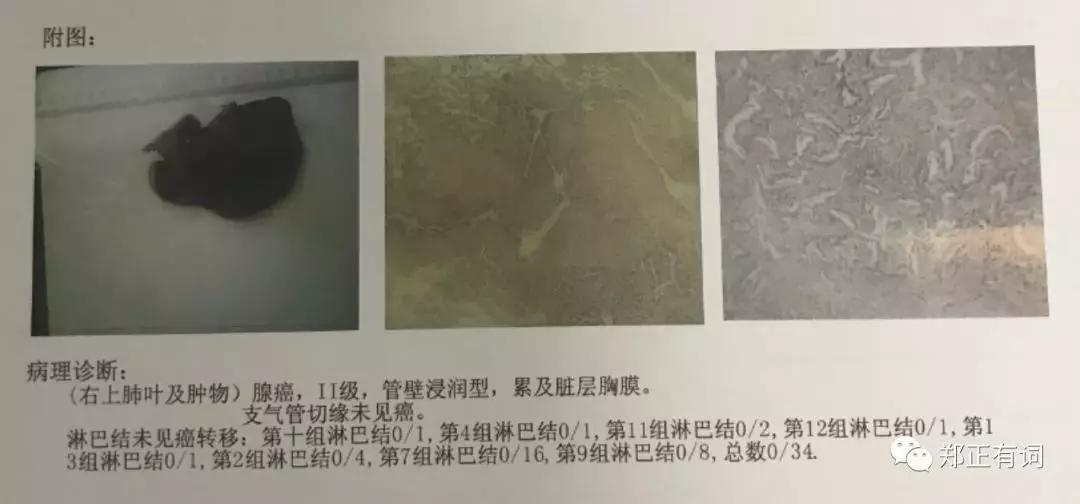 心肺功能特别差能动肺手术吗,肺癌想做手术呼吸功能差怎么办