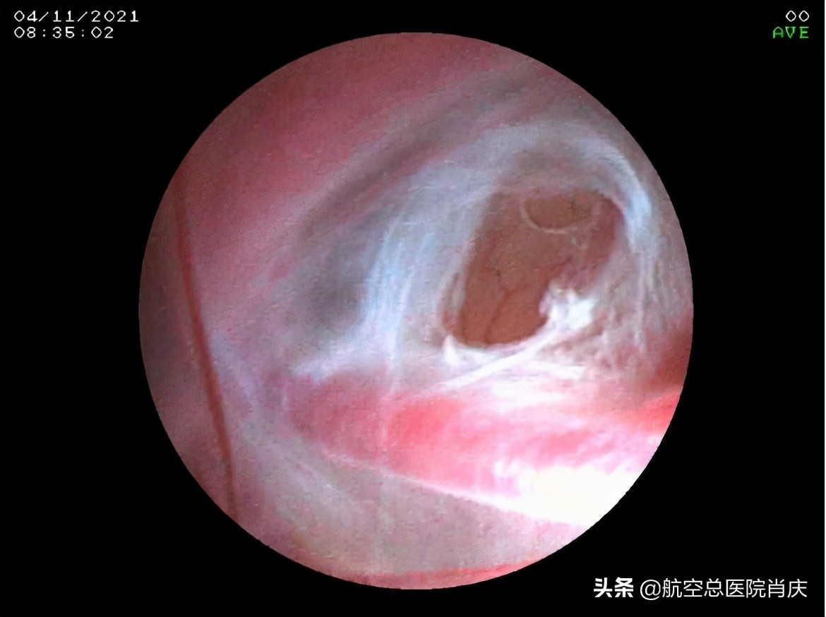 鞍上池蛛网膜囊肿手术费用,鞍上池蛛网膜囊肿影响智力吗