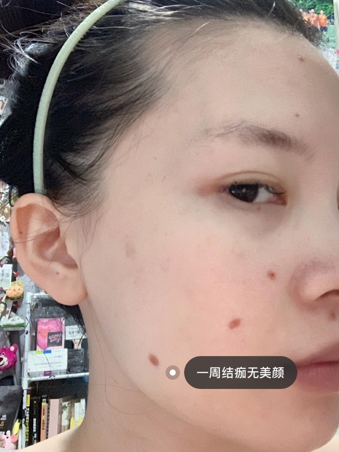 激光点痣护理推荐哪些产品,激光点痣的坑能长平吗