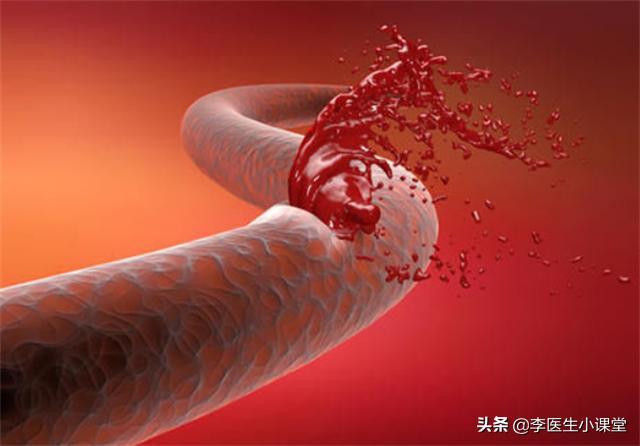 血压高突发脑出血怎么治疗30岁,高血压脑出血突然发作该如何急救