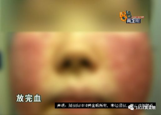 扎针放血真是痛,皮下淤血肿了扎针放血