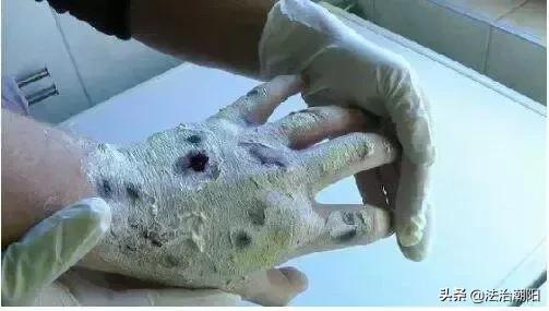 *毒冰**疮、*古麻**痘，拿什么来拯救这张脸？