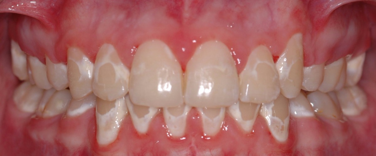 牙齿蛀牙怎么治疗,治疗蛀牙的视频