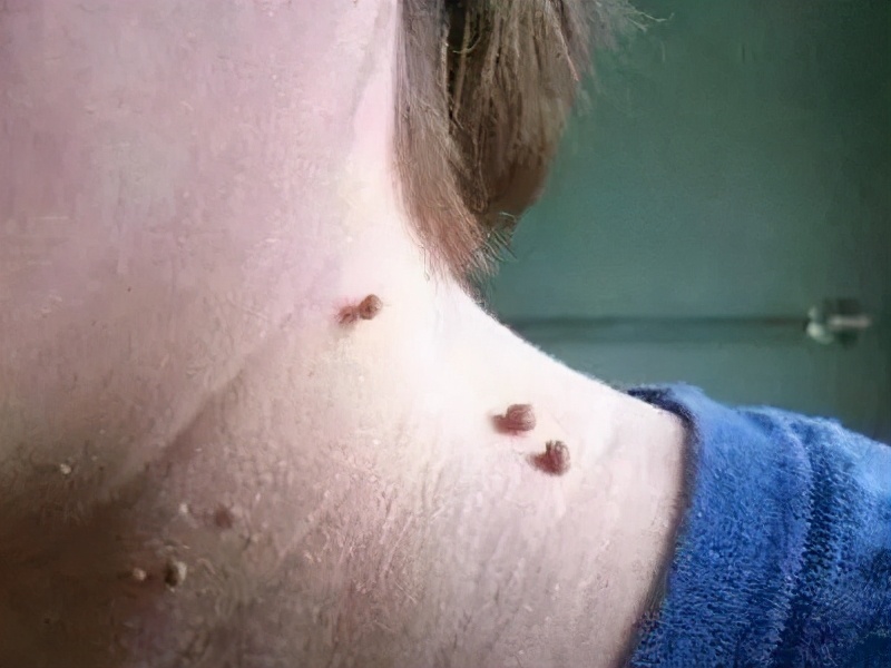 脖子腋下腹股沟长小肉粒怎么去除,腋下脖子上长小肉粒是什么原因