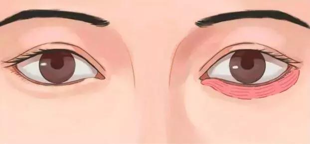 眼袋怎么消除简单方法男生,黑眼袋怎么消除最快方法男士