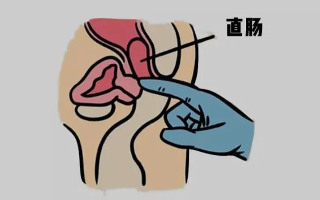 直肠癌指检能查出什么,肛肠指检能排除多少概率得直肠癌