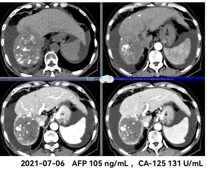 肝癌晚期靶向治疗怎么做,中国肝癌tace治疗展望
