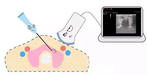 120万一针治疗肿瘤,肿瘤免疫针多少钱一针