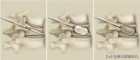 没有外伤怎么会肋骨骨折,没有外伤腰椎骨折是什么原因