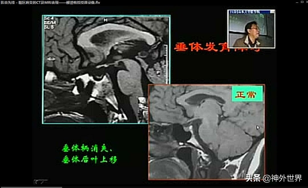 鞍区解剖学习笔记之——垂体