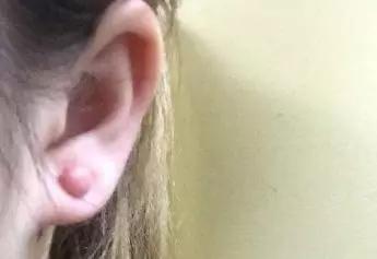 小孩手术疤痕体质怎么除疤,激光除疤适用于疤痕体质吗