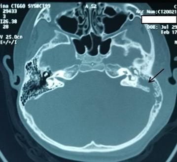 严重的儿童中耳炎——一个有惊无险的小故事