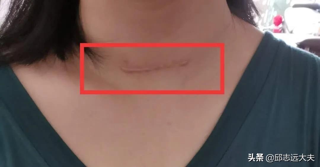 小孩伤口怎么不留疤,伤口怎么不留疤快速恢复