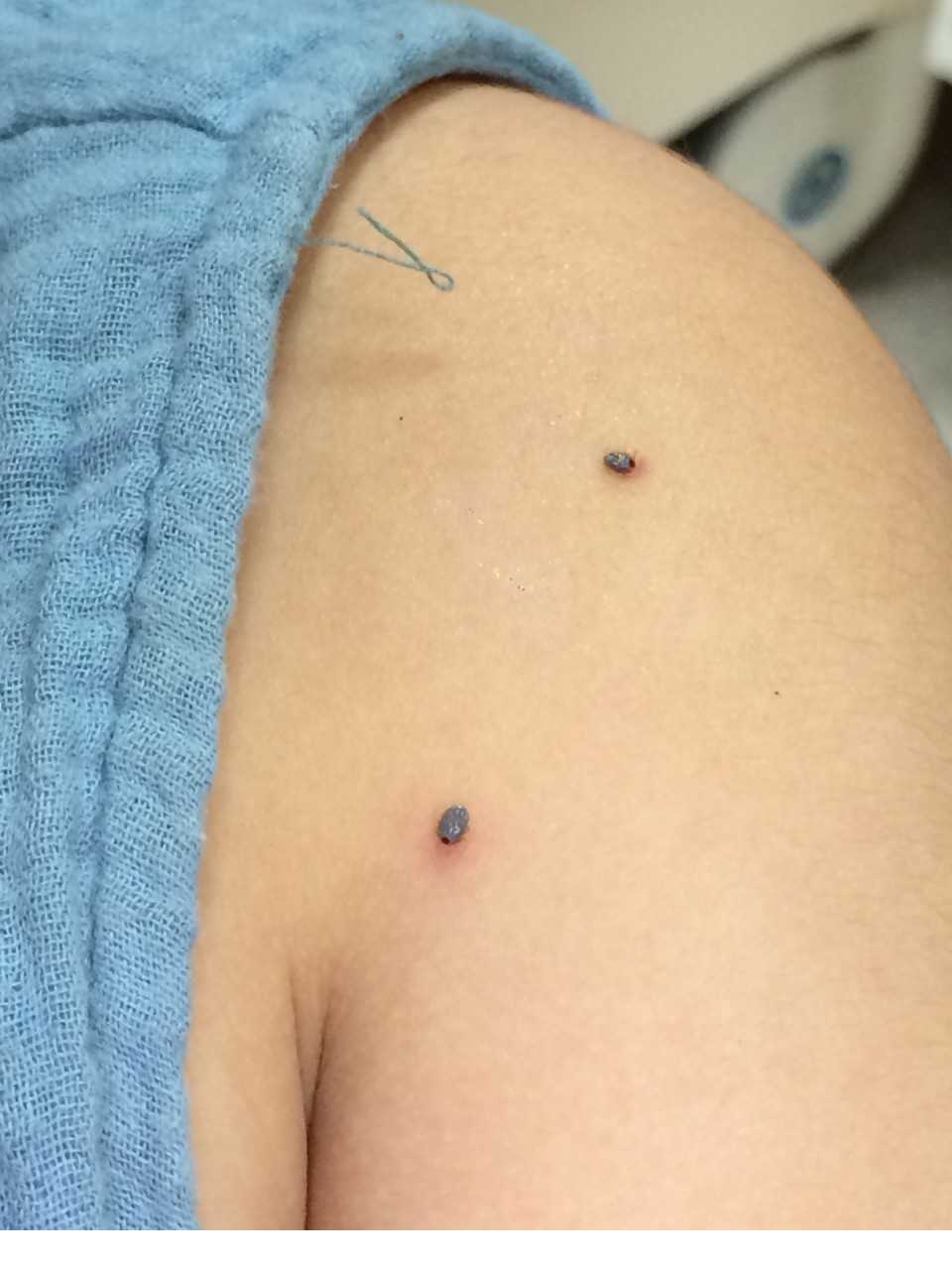 野钓需要注意的寄生虫,野外钓鱼如何防寄生虫