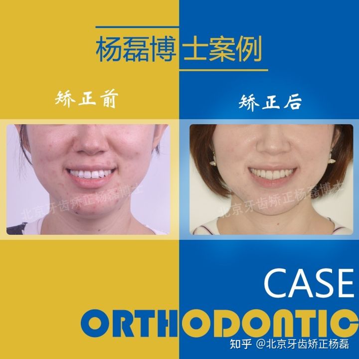 北京牙齿矫正大约要多少钱,北京哪个医院看牙齿矫正比较好