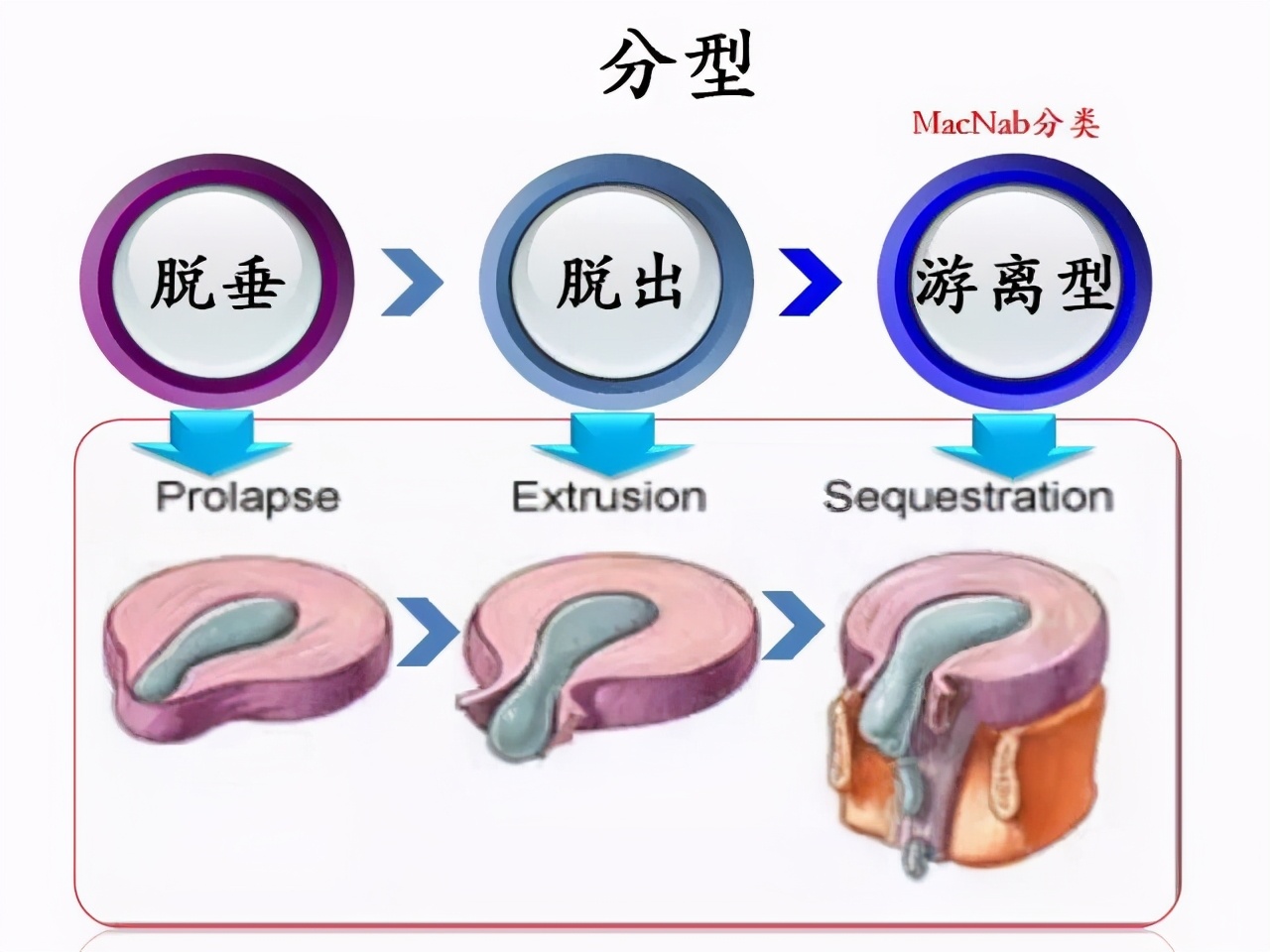 腰椎增生和腰间盘突出哪个更严重,腰椎间盘突出3毫米5毫米严重吗