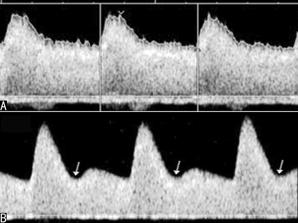 明明白白做超声23-2：妊娠期子宫及卵巢超声多普勒检查