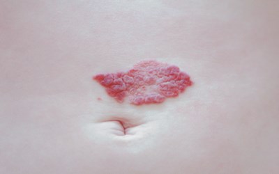 浅表血管瘤草莓状血管瘤怎么治疗,婴儿草莓状血管瘤怎么引起的