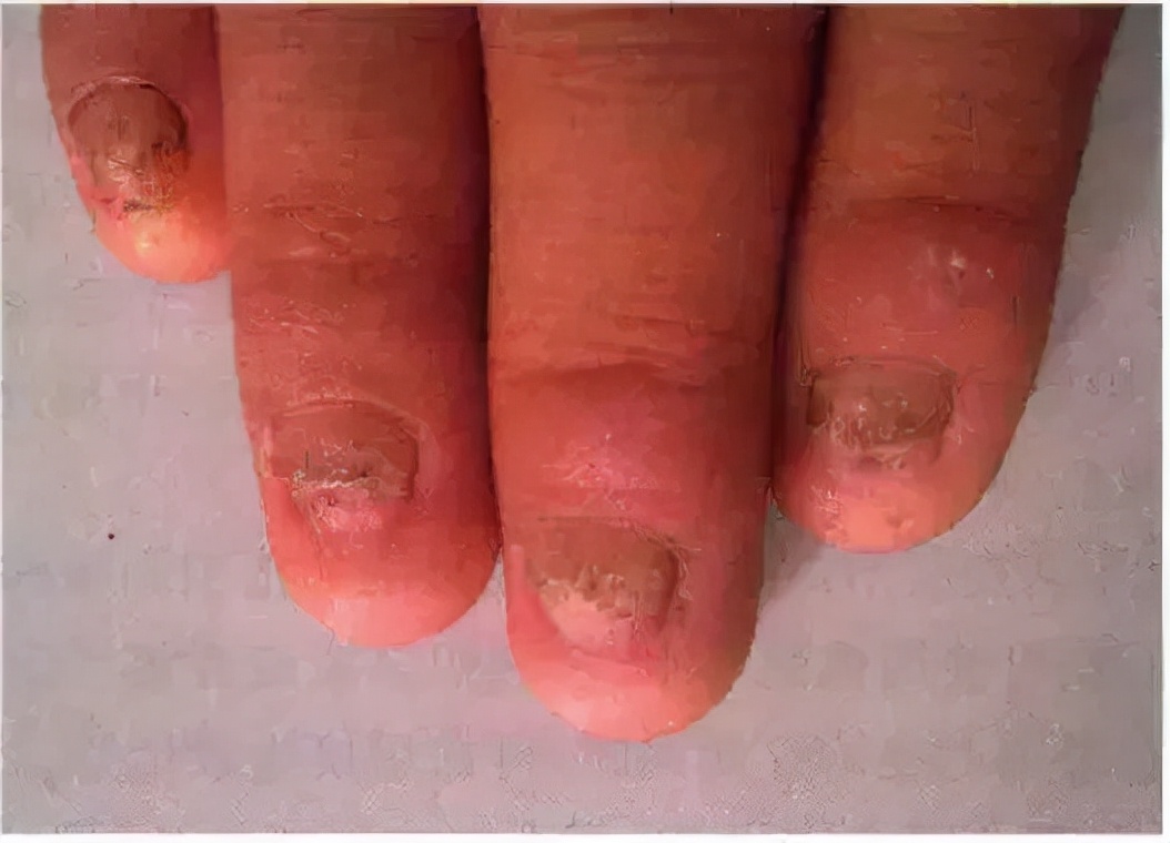 右脚大拇指甲变厚变黄竖纹啥意思,涨知识现象