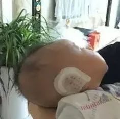 出生宝宝耳朵耳廓畸形判断,新生婴儿耳廓畸形圆耳