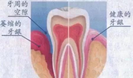 牙龈萎缩艾灸哪里最好,艾灸后牙龈萎缩好了