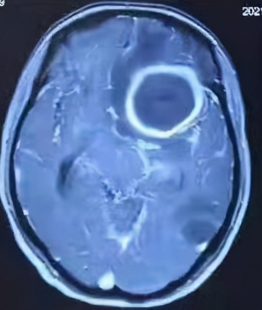 不做穿刺引流肝脓肿一般能好吗,大脑有囊肿需要做开颅手术吗