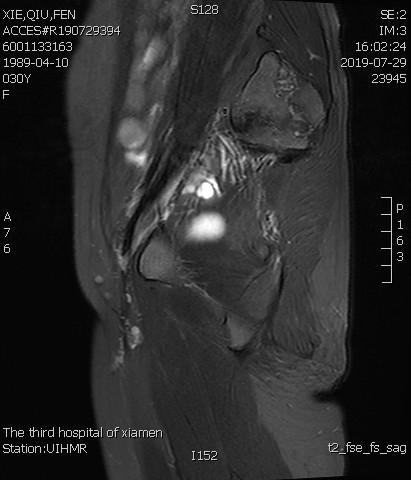 子宫腺肌症介入栓塞全国哪里好,子宫腺肌症介入栓塞治疗报销吗