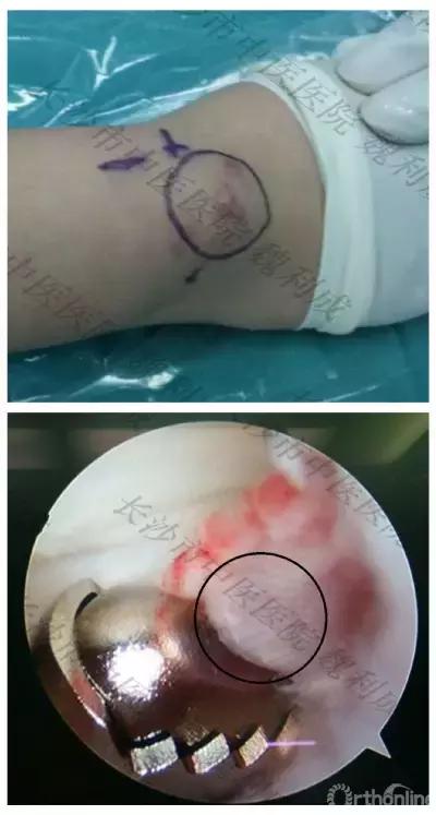 手腕囊肿抽吸出来后可否继续按压,足背囊肿穿刺好还是切除好