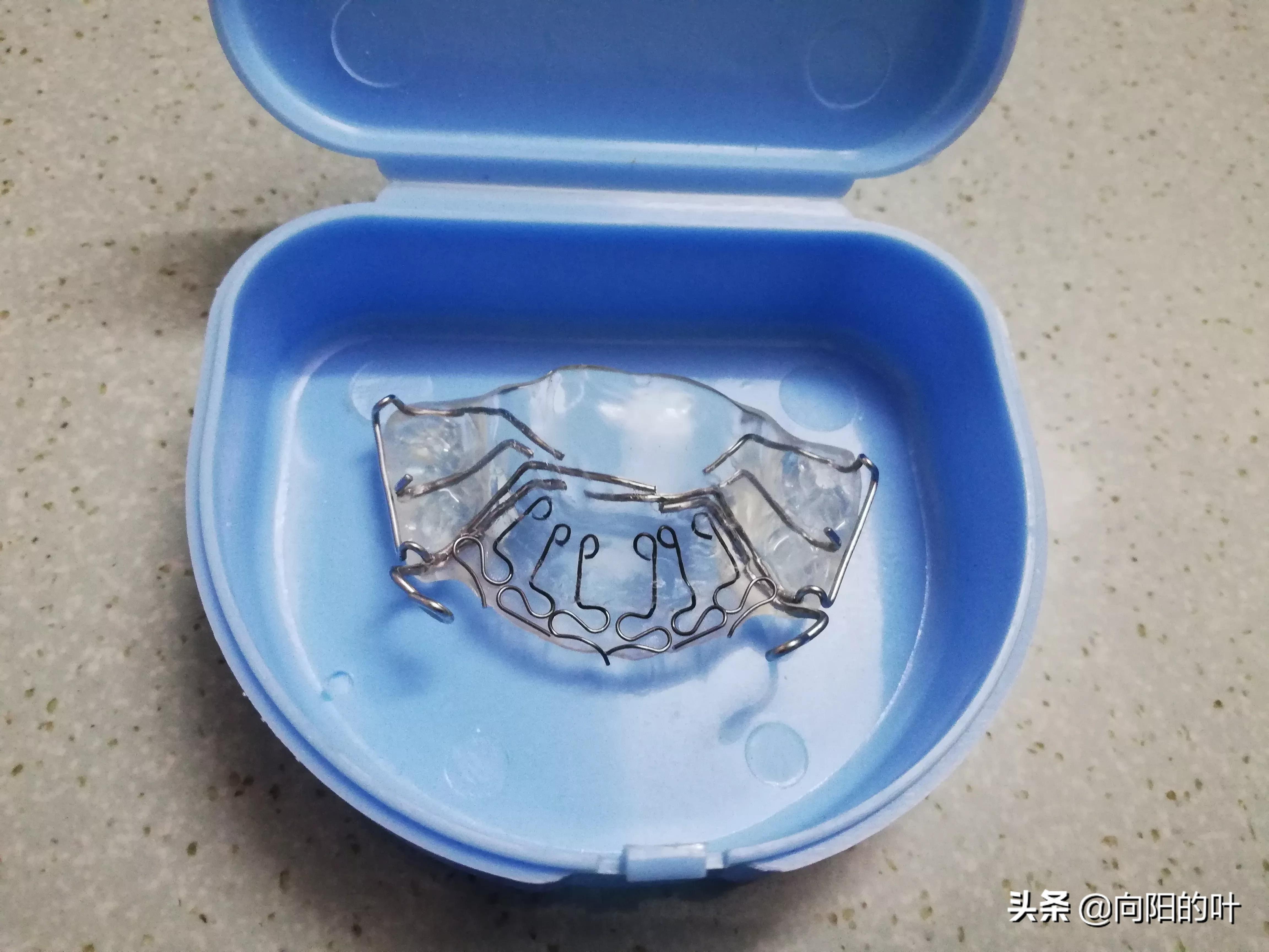 记录小儿兜牙治疗:开始带牙套了