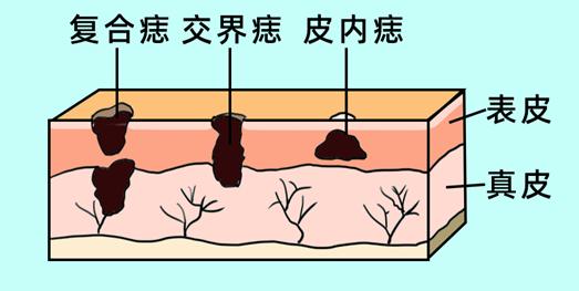 科普一颗平淡无奇的痣竟然会癌变,痣癌变的信号有哪些