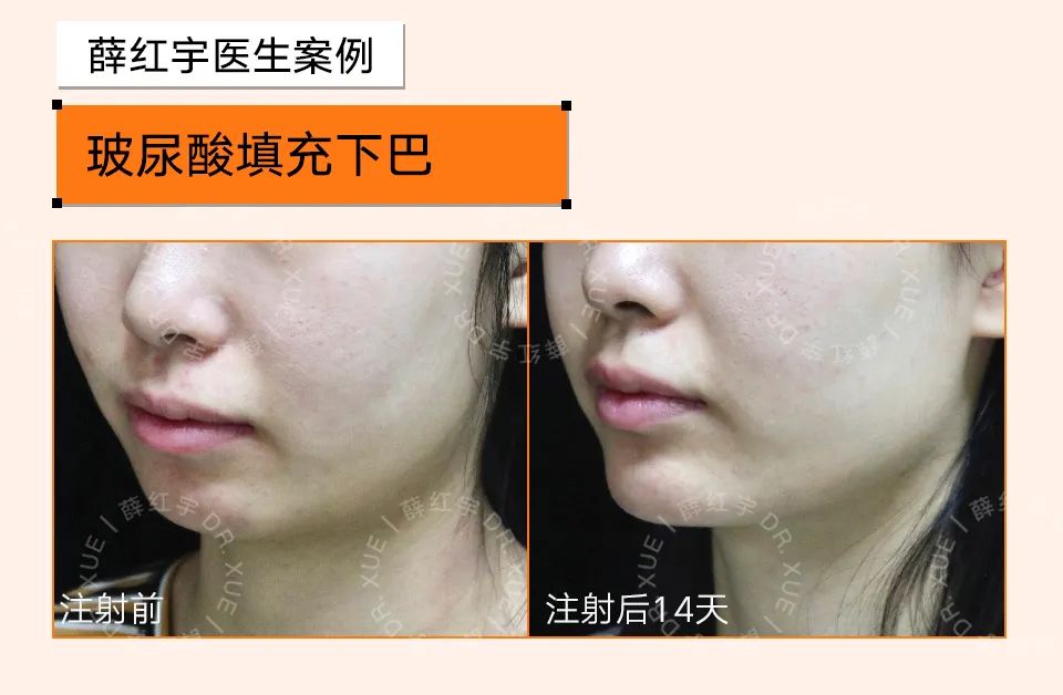 让下颚越来越清晰,下颌缘不清晰的原因